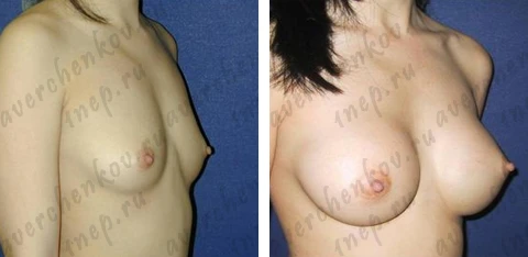 Эндоскопическое увеличение груди. Каплевидный имплант объемом 290 сс, подмышечный доступ, расположение импланта под большой грудной мышцей Эндоскопическое увеличение груди. Каплевидный имплант объемом 290 сс, подмышечный доступ, расположение импланта под большой грудной мышцей