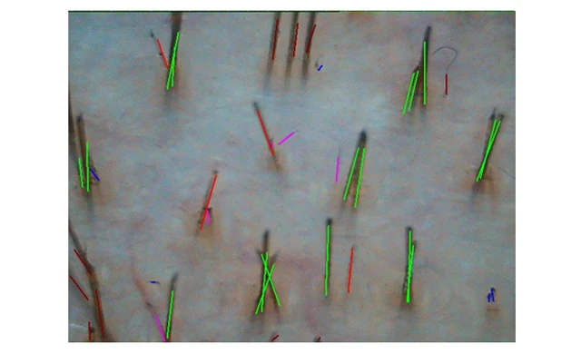 Затылочная зона на фототрихограмма при диффузном выпадении волос Затылочная зона на фототрихограмма при диффузном выпадении волос