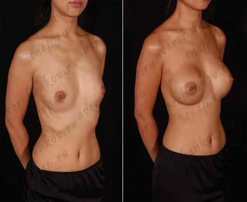 Эндоскопическая маммопластика. Круглый имплант объемом 280 сс, доступ подмышечный, расположение импланта под железой Эндоскопическая маммопластика. Круглый имплант объемом 280 сс, доступ подмышечный, расположение импланта под железой