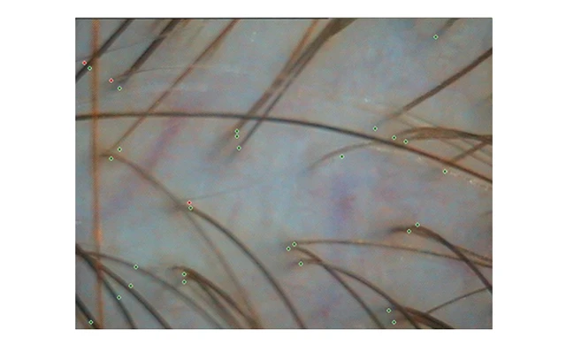 Затылочная зона при диффузном выпадении волос Затылочная зона при диффузном выпадении волос