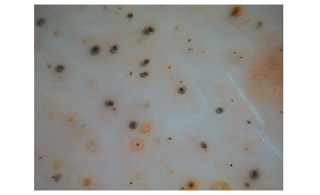 Диагностика гнездой алопеции Диагностика гнездой алопеции