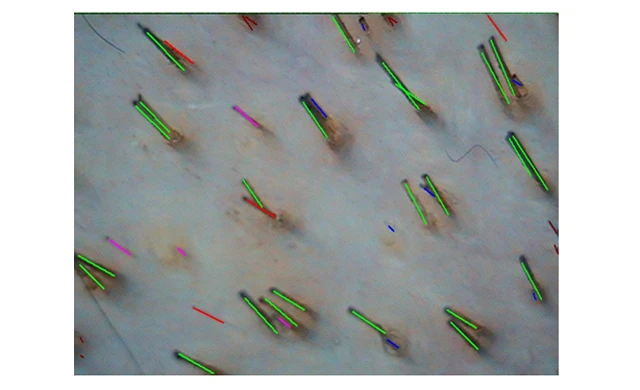 Теменная область на фототрихограмма при диффузном выпадении волос Теменная область на фототрихограмма при диффузном выпадении волос