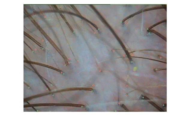 Теменная зона при андрогенетической алопеции Теменная зона при андрогенетической алопеции