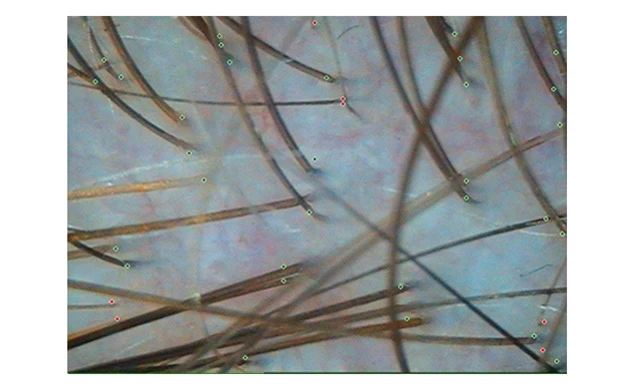 Затылочная зона при андрогенетической алопеции Затылочная зона при андрогенетической алопеции