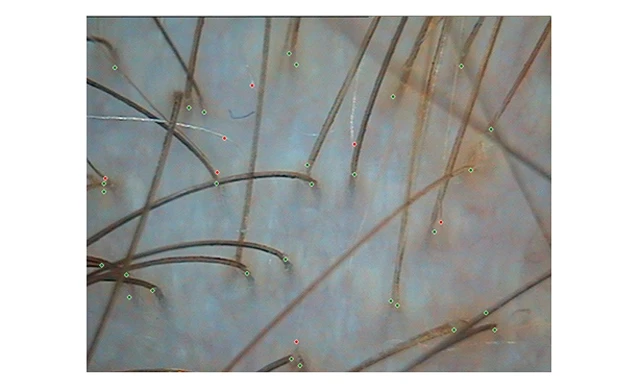 Теменная зона при диффузном выпадении волос Теменная зона при диффузном выпадении волос