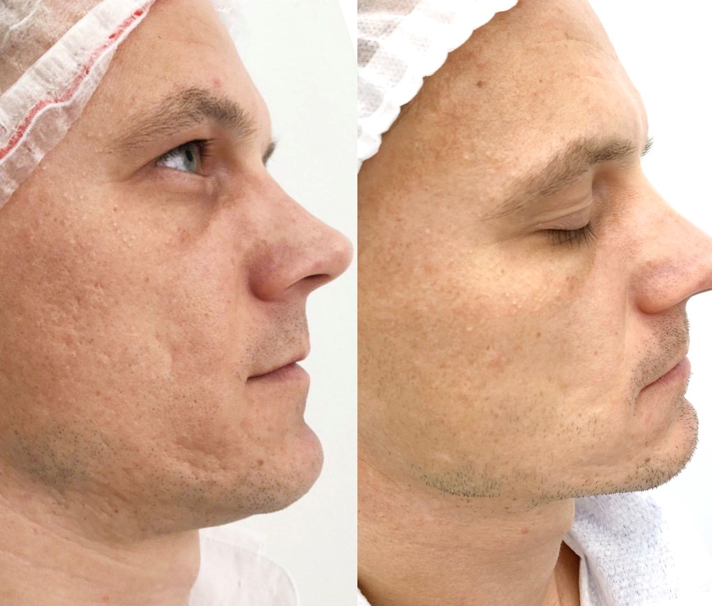 Мезороллер фото до и после применения для лица