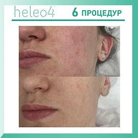 Heleo4 Pro LED